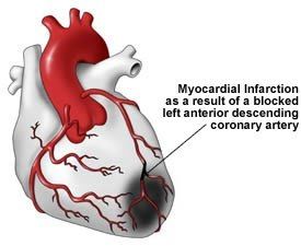 pm 2.5 Myocardial-infarction-LAD-obstruction